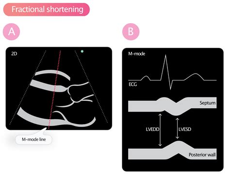 lv shortening fraction vs ejection.